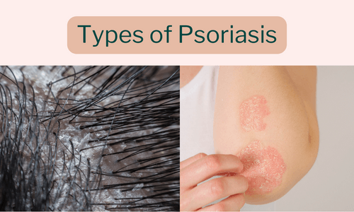 Types of Psoriasis - Oleum Cottage