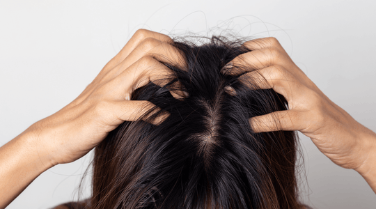 A Guide to Scalp Psoriasis - Oleum Cottage