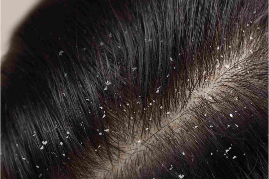 How to treat Dandruff at home - Oleum Cottage