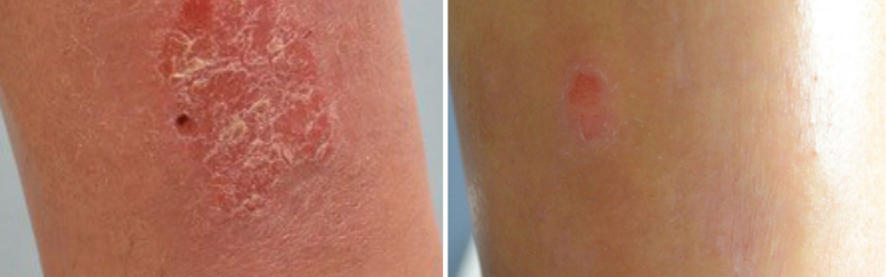 Ultra Healing Cream for Eczema Patches & Flare Ups – Oleum Cottage